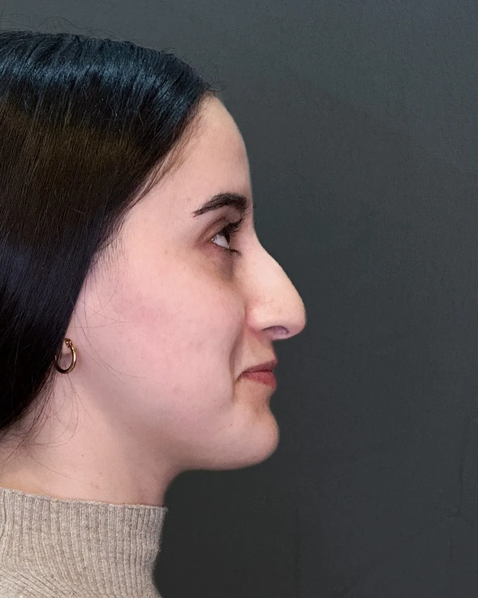 Antes de rinoseptoplastia, perfil derecho. Paciente del Dr. Rodrigo Fernández