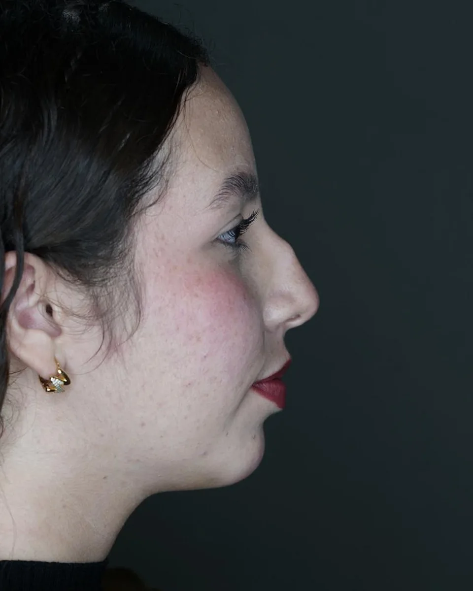 Antes de rinoseptoplastia, perfil derecho. Paciente del Dr. Rodrigo Fernández