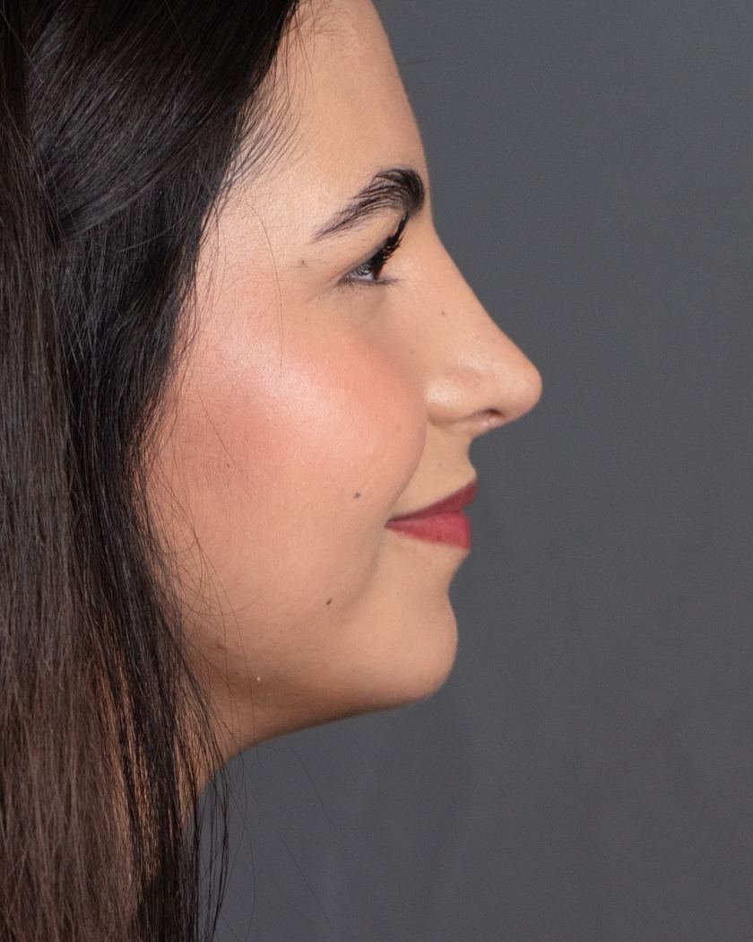 Perfil de una paciente después de su rinoplastia con el Dr. Rodrigo Fernández